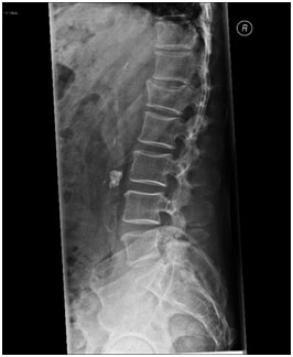 Vertebral Compression Fractures Pain Treatment Westmead, NSW